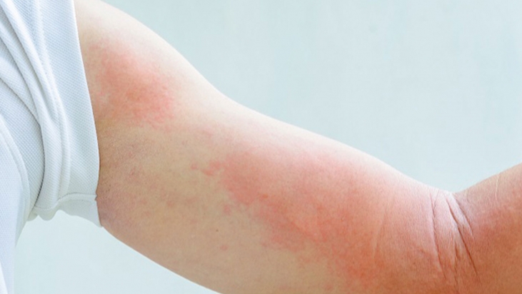Urticaria, Dermatitis por contacto y Dermatitis Atópica en tiempos de COVID-19