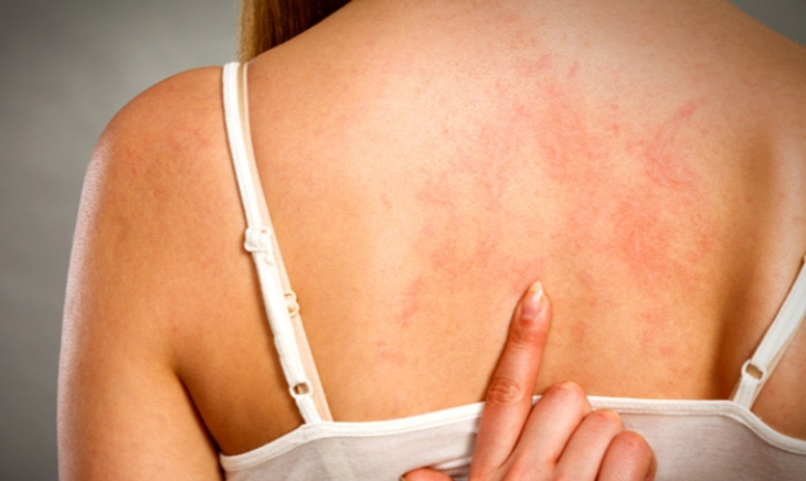 1 de octubre: Día Mundial de Concientización acerca de la Urticaria Crónica